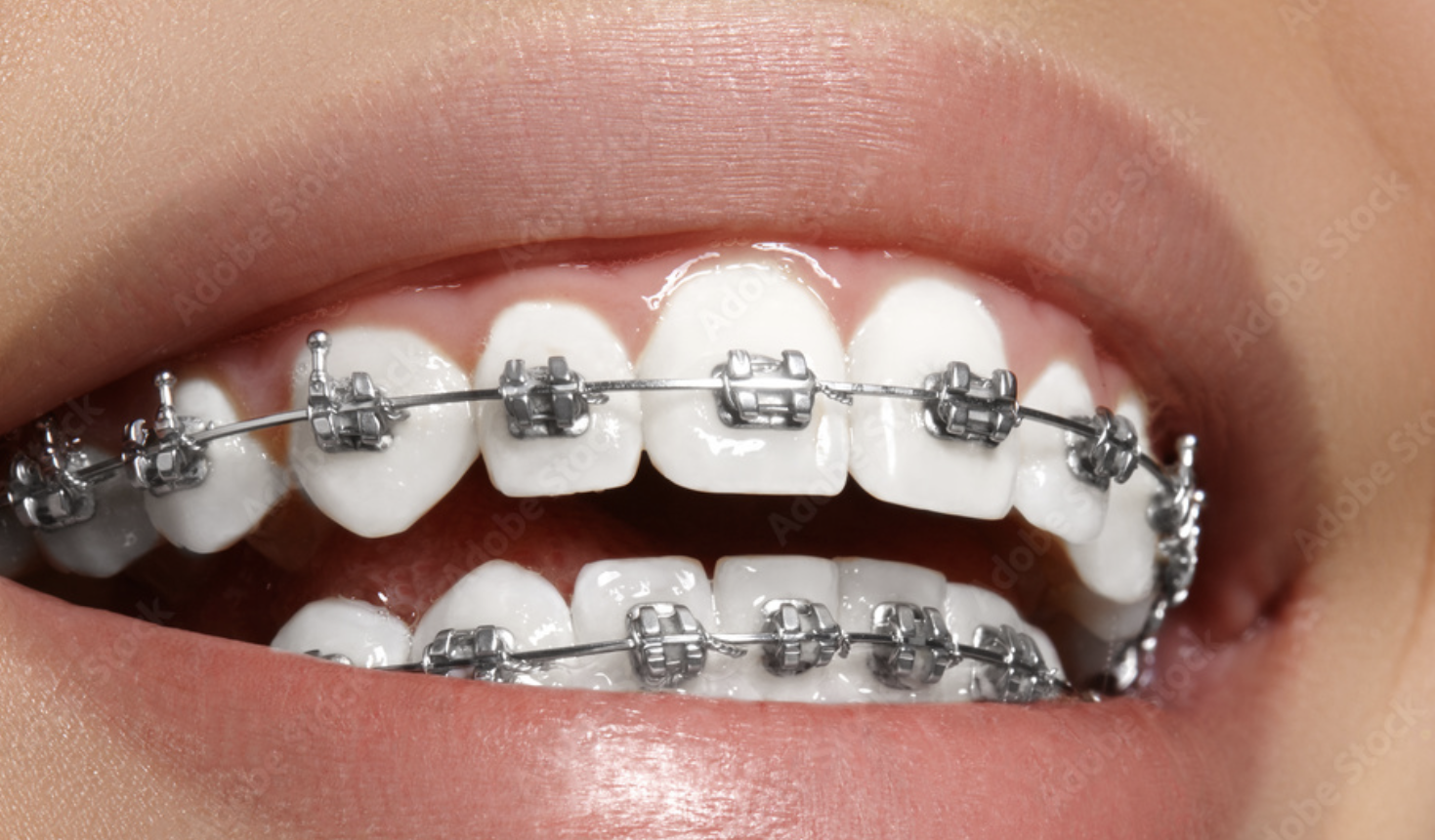 Zamki tradycyjne metalowe