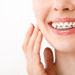 Orthodontic Treatment. Dental Care Concept. Beautiful Woman Healthy Smile close up. Closeup Ceramic and Metal Brackets on Teeth. Beautiful Female Smile with Braces.